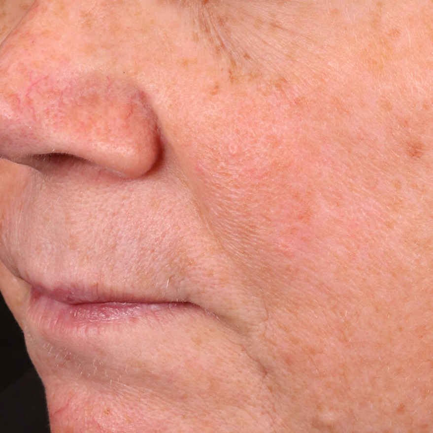 A female patient after using BIOJUVE.