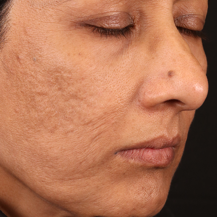 A female patient after using BIOJUVE.