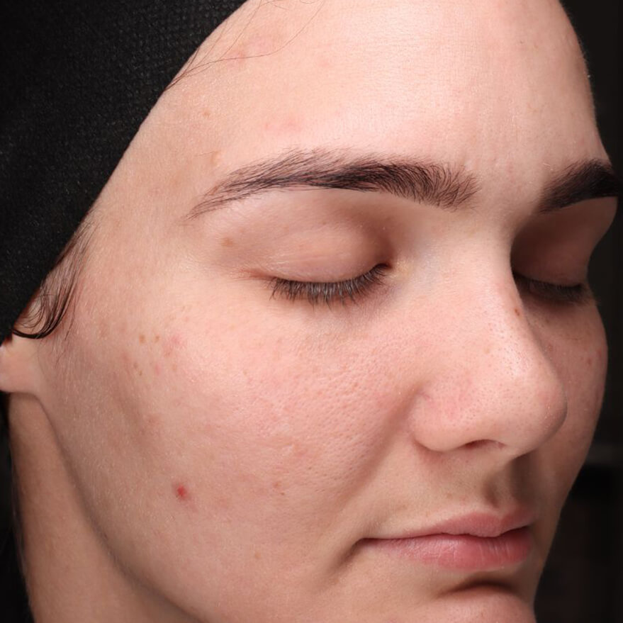 A female patient after using BIOJUVE.